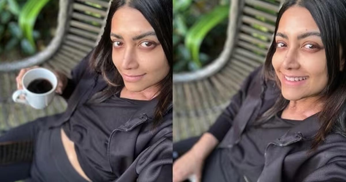 ত্বকের রোগে সৌন্দর্য হারাচ্ছেন এই নায়িকা