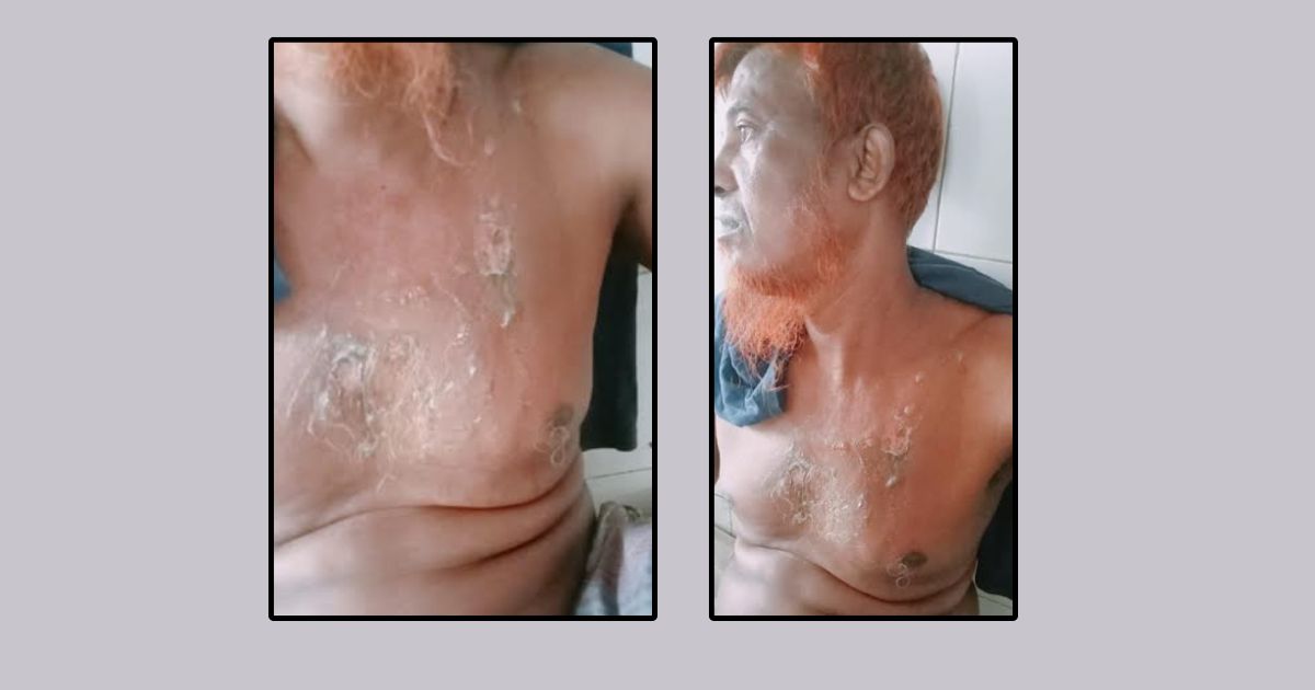 গরম চা দিয়ে চা দোকানীকে ঝলসে দিল তরুণী