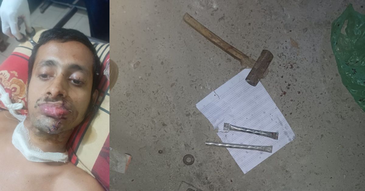 টুঙ্গিপাড়ায় বিস্ফোরণে দগ্ধ যুবক: আতশবাজি নাকি বোমা তৈরির চেষ্টা, তদন্তে পুলিশ