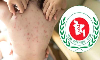 হাম ও হামের উপসর্গ নিয়ে ৩ শিশুর মৃত্যু