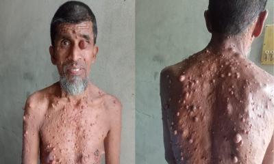 বাঁচতে চান বিরল রোগে আক্রান্ত ভাঙ্গুড়ার হাবিবুল্লাহ