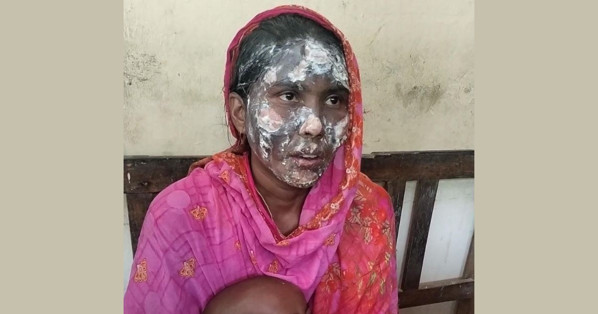 পীরগঞ্জে স্বামীর পরকীয়ার জের ধরে স্ত্রীর মুখ পুড়িয়ে দিলেন স্বামী