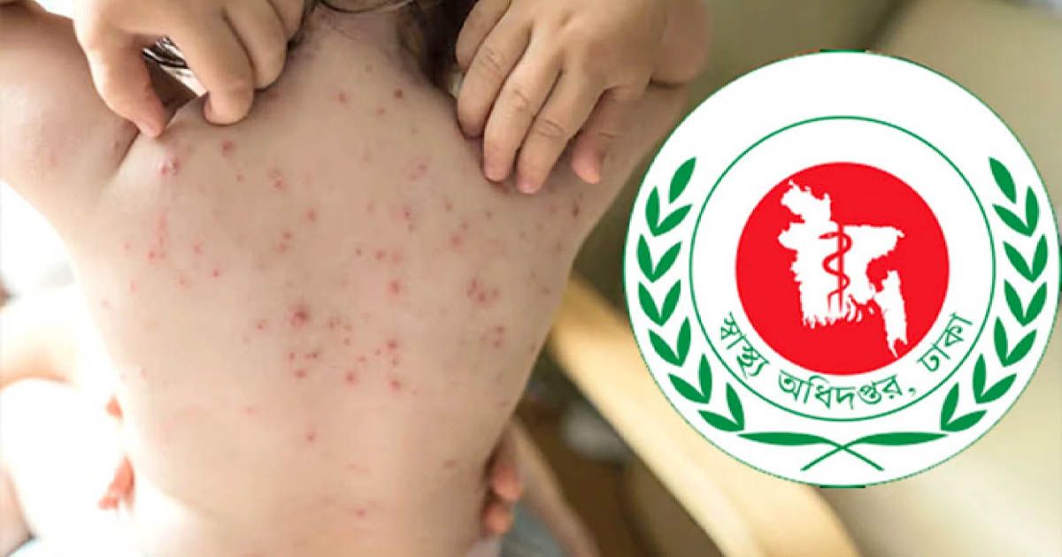 হাম ও হামের উপসর্গ নিয়ে ৩ শিশুর মৃত্যু