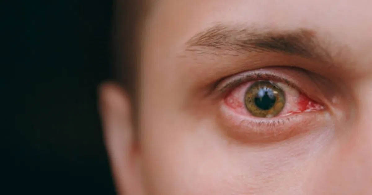 কিশোরদের চোখের সমস্যা কমাতে প্রতিদিনের সহজ ঘরোয়া পরামর্শ 